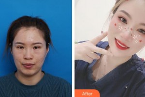 鹿邑眼科醫(yī)院李金榮整形價格表附激光去眼袋案例展示