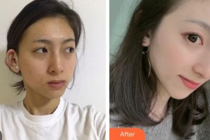 宜興市皮膚病醫(yī)院醫(yī)療美容科談君林整形價(jià)格表附微創(chuàng)疤痕修復(fù)案例展示