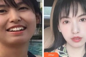 濟(jì)源向日葵口腔門診部武江波整形價格表附金屬托槽矯正案例展示