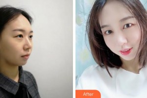 大理華山眼科醫(yī)院李敏整形價(jià)格表附切開雙眼皮案例展示