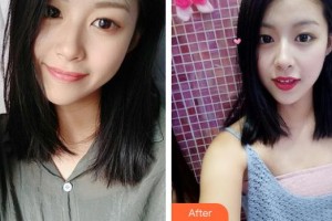 唐河?xùn)|方眼科醫(yī)院李斌整形價(jià)格表附切開(kāi)雙眼皮案例展示