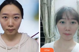 郯城新益民眼科醫(yī)院孫鼎整形價(jià)格表附上眼瞼去脂案例展示