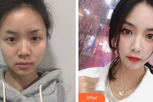 邯鄲華美醫(yī)療美容醫(yī)院姜勝勛整形價格表附紅藍光祛痘案例展示