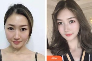 邯鄲凱潤(rùn)婷整形美容醫(yī)院李靈玲整形價(jià)格表附切開(kāi)雙眼皮案例展示