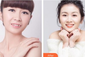 邯鄲佑熙醫(yī)療美容門診部孫堅整形價格表附隱形托槽矯正案例展示