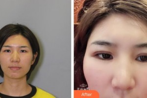 漢口愛爾眼科醫(yī)院陳茜整形價格表附切開雙眼皮案例展示