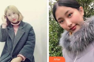 漢口愛爾眼科醫(yī)院呂露整形價格表附切開雙眼皮案例展示