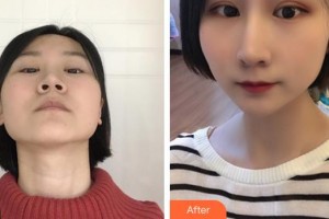 深圳愛爾眼科醫(yī)院常征整形價(jià)格表附眼部綜合案例展示