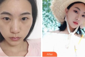 深圳愛爾眼科醫(yī)院金童實(shí)整形價(jià)格表附眼部綜合案例展示