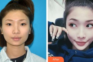 深圳愛爾眼科醫(yī)院鐘華紅整形價(jià)格表附內(nèi)切祛眼袋案例展示