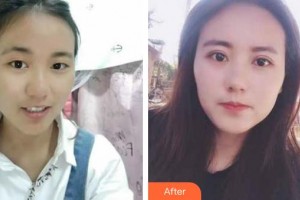 深圳愛爾眼科醫(yī)院慕明燕整形價(jià)格表附切開雙眼皮案例展示