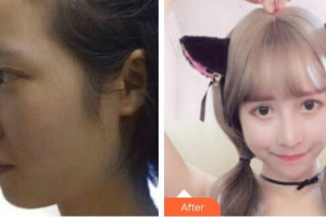 深圳愛爾眼科醫(yī)院徐超然整形價(jià)格表附切開雙眼皮案例展示