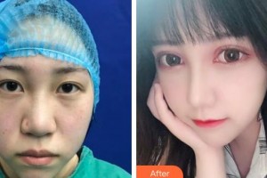 深圳愛爾眼科醫(yī)院馬慧明整形價(jià)格表附切開雙眼皮案例展示