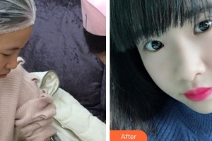 深圳愛爾眼科醫(yī)院柯妍整形價(jià)格表附切開雙眼皮案例展示