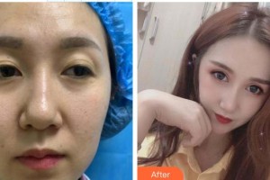 深圳愛爾眼科醫(yī)院李敏超整形價(jià)格表附眼部綜合案例展示