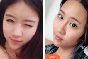 深圳愛爾眼科醫(yī)院成躍偉整形價(jià)格表附內(nèi)切祛眼袋案例展示