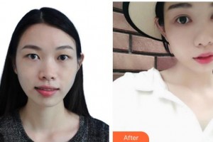深圳?，斄猪槼毖劭漆t(yī)院施禮康整形價格表附切開雙眼皮案例展示