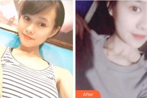 深圳?，斄猪槼毖劭漆t(yī)院孫紅整形價格表附切開雙眼皮案例展示