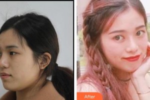 深圳?，斄猪槼毖劭漆t(yī)院尉洋整形價格表附眼部綜合案例展示