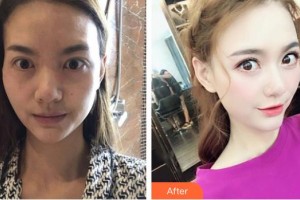 深圳?，斄猪槼毖劭漆t(yī)院袁野整形價格表附眼部修復(fù)案例展示