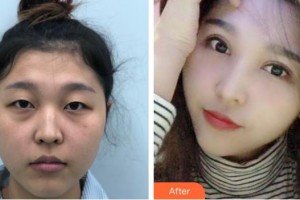 深圳?，斄猪槼毖劭漆t(yī)院林小銘整形價格表附眼部綜合案例展示