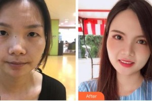 深圳?，斄猪槼毖劭漆t(yī)院舒敏整形價格表附切開雙眼皮案例展示