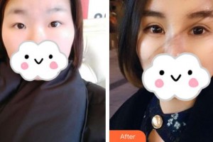 深圳?，斄猪槼毖劭漆t(yī)院范偉整形價格表附眼部綜合案例展示
