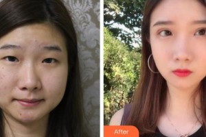 深圳?，斄猪槼毖劭漆t(yī)院林妙麗整形價格表附眼部整形雙眼皮案例展示