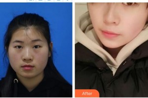 深圳希瑪林順潮眼科醫(yī)院陳麗珍整形價格表附眼部綜合案例展示