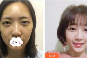 深圳杏雙醫(yī)療美容醫(yī)院姚歐整形價格表附眼部綜合案例展示