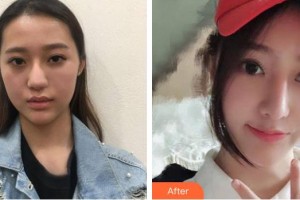 懷化市第一人民醫(yī)院鄧德向整形價格表附鼻部綜合案例展示