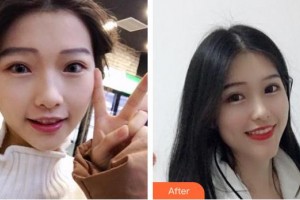 東莞特美口腔門診部歐陽軍輝整形價格表附牙齒隱形矯正案例展示