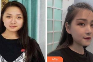 東莞君熠醫(yī)療美容診所丁潔整形價(jià)格表附鼻部綜合案例展示