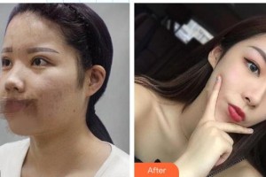 東莞西妃醫(yī)療美容醫(yī)院任家驃整形價格表附鼻部綜合案例展示