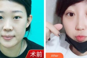 潮州博蘭雅醫(yī)療美容門診部劉惠珊整形價(jià)格表附鼻部綜合案例展示