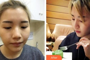 潮州博蘭雅醫(yī)療美容門診部胡龍整形價(jià)格表附鼻部綜合案例展示
