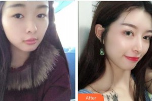 慈溪圣愛(ài)醫(yī)院整形美容科鄭聰聰整形價(jià)格表附鼻部綜合案例展示