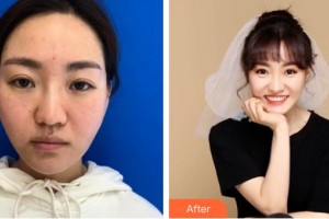 溫嶺醫(yī)美佳醫(yī)療美容診所韓松哲整形價(jià)格表附埋線提升案例展示