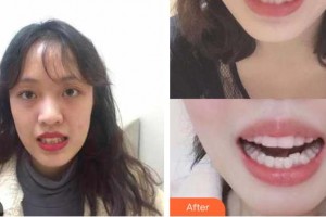 陽春口腔醫(yī)院盧東曉整形價格表附牙齒隱形矯正例展示