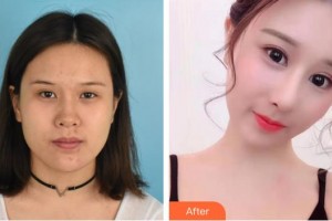 興義時(shí)光整形美容醫(yī)院劉彪整形價(jià)格表附假體隆鼻案例展示