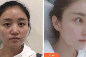 河源曙光醫(yī)療美容門診部石潤整形價(jià)格表附假體隆鼻案例展示