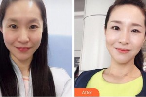 瀏陽康美醫(yī)療美容門診部鄒笑寒整形價(jià)格表附嗨體去頸紋案例展示