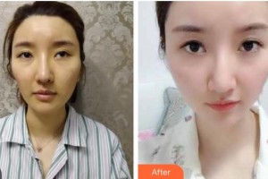 瀏陽康美醫(yī)療美容門診部杜亞妮整形價(jià)格表除皺案例展示