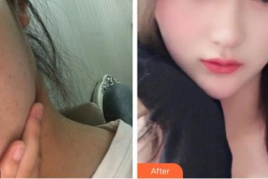 李國偉整形價(jià)格表附激光美膚激光案例展示