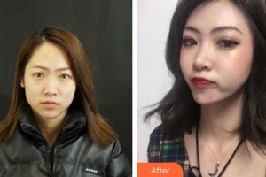 整形價(jià)格表附鼻部綜合案例展示