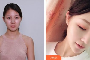 溧陽智多星醫(yī)療美容門診部聶烽整形價(jià)格表附埋線提升案例展示