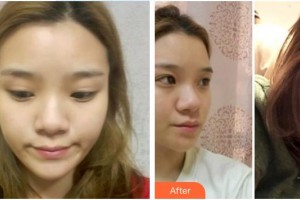渭南海成皮膚?？漆t(yī)院韓海成整形價(jià)格表附熱拉提案例展示