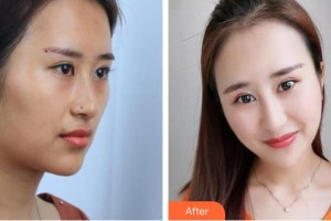 揭陽華美整形美容醫(yī)院魯利兵整形價格表附超聲波潔牙案例展示
