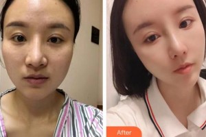 漢川麗萊醫(yī)療美容醫(yī)院胡瑾整形價格表附射頻緊膚案例展示