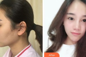 侯馬晨暉醫(yī)學美容門診部李晉才整形價格表附埋線提升案例展示